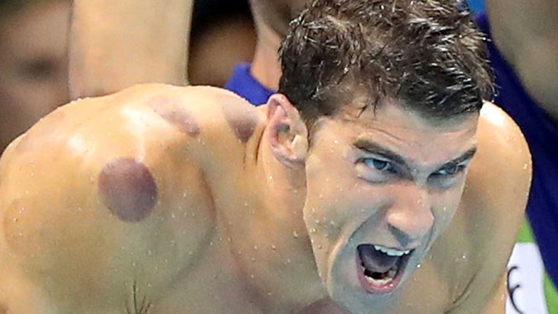 Michael Phelps AP cupping